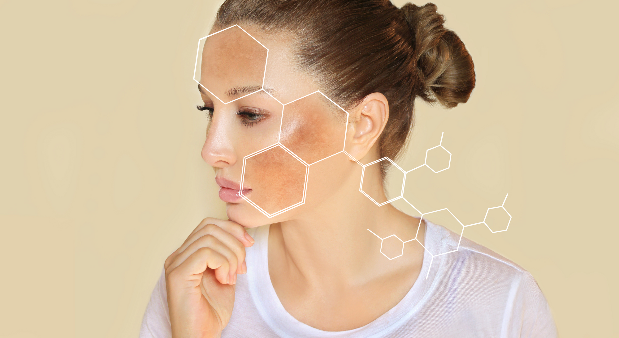 ¿Cómo evitar el melasma?